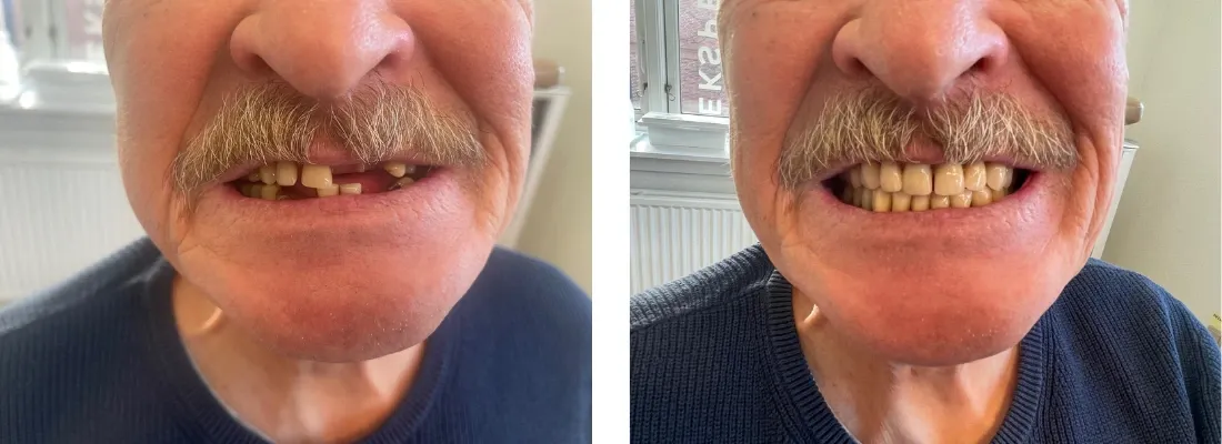 På billedet ses en før og efter sammenligning af en tandprotesebehandling.